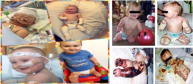 Children Meningitis Vaccine